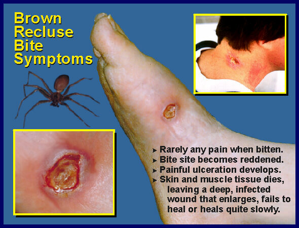 symptoms of brown recluse bites